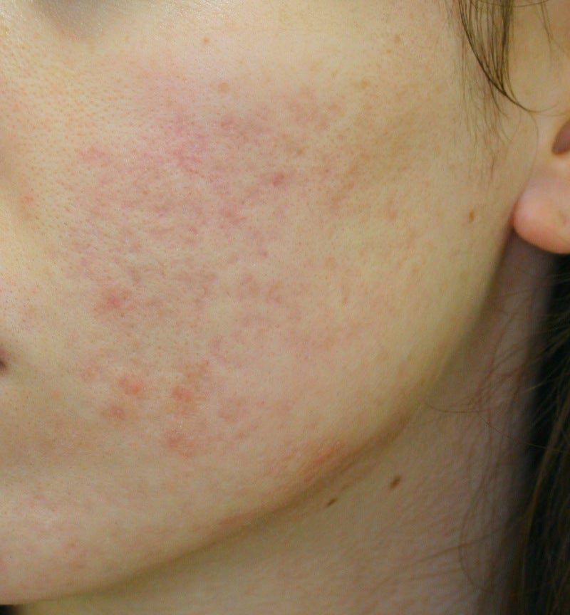 ¿Cómo eliminar el acné en la cara?