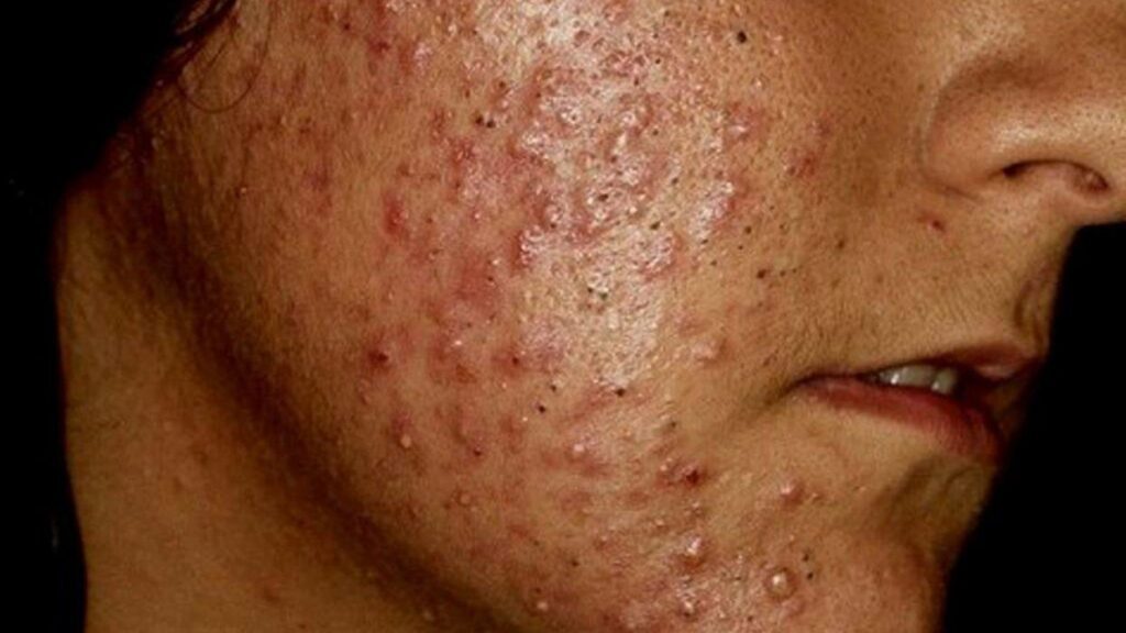 ¿Cómo eliminar el acné en la cara?