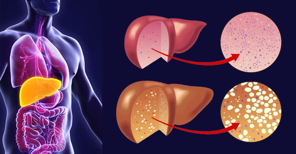 Cómo eliminar el exceso de grasa del hígado