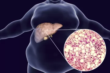 Cómo eliminar el exceso de grasa del hígado
